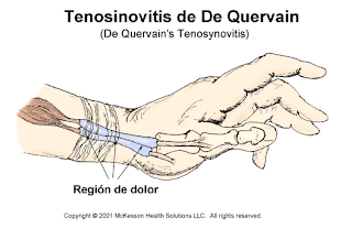 Resultado de imagen para Tendinitis y tenosinovitis