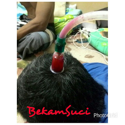  Permalink http://bekamsuci.blogspot.com/2015/12/hilangkan-migrain-dengan-bekam-tanpa.html