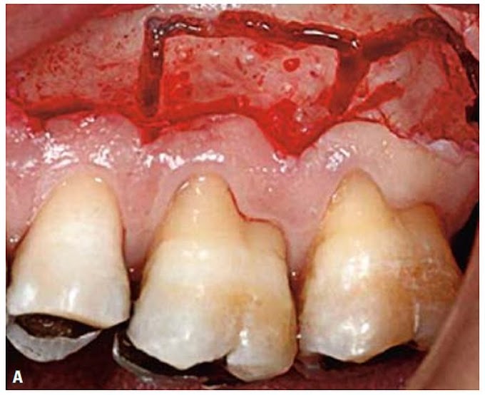 PDF: Corticotomias alveolares na Ortodontia: indicações e efeitos na movimentação dentária