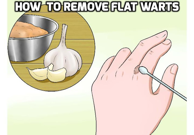 If you want to remove your flat warts, read on here to find out the 3 main types of flat wart removal methods.