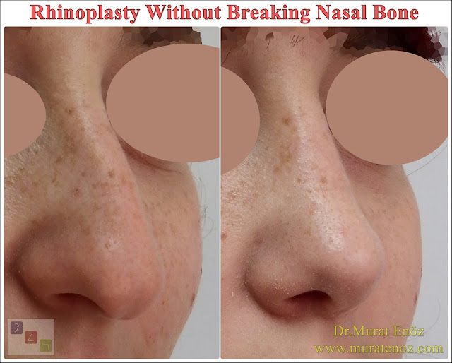 Nose Job Without Bone Broken, Rhinoplasty Without Breaking The Nasal Bone in Istanbul