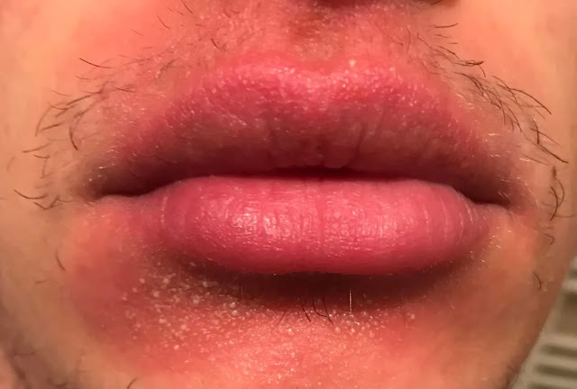 small bumps around mouth