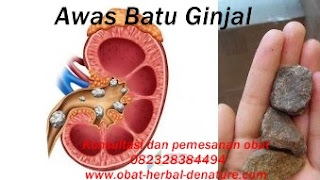 cara menghancurkan batu ginjal tanpa operasi,obat batu ginjal,obat kencing batu,cara mengeluarkan batu ginjal tanpa operasi,cara menghilangkan batu ginjal tanpa operasi