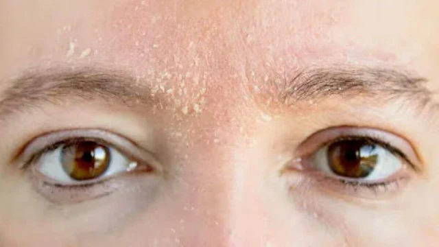 Restoring Radiant Skin: Effective Treatments for Dry Peeling Skin on Face