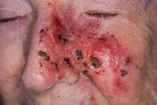 skin cancer pictures on face