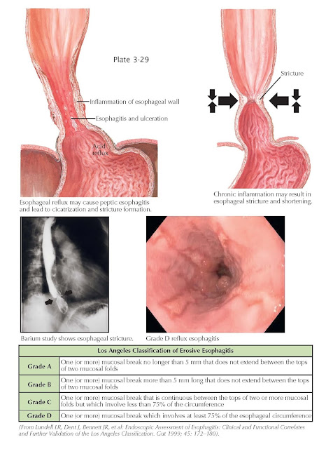 Reflux Esophagitis