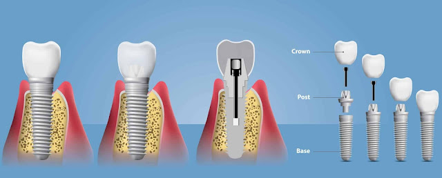 How Dental Implants Are Changing Lives?