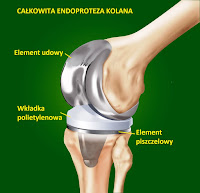 endoproteza kolana na ile lat; operacja kolana jak długo w szpitalu; życie z endoprotezą kolana