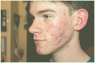 como quitar el acne por estres