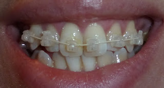 A front on photograph of teeth with ceramic fixed braces at at start of treatment