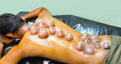 Hijama,blog,Treatment by hijama,hijama for gallstones,hijama for gastritis,hijama for gas trouble,Cupping for gallbladder stone,Hijama Treatment for Gallbladder Stones,hijama therapy,