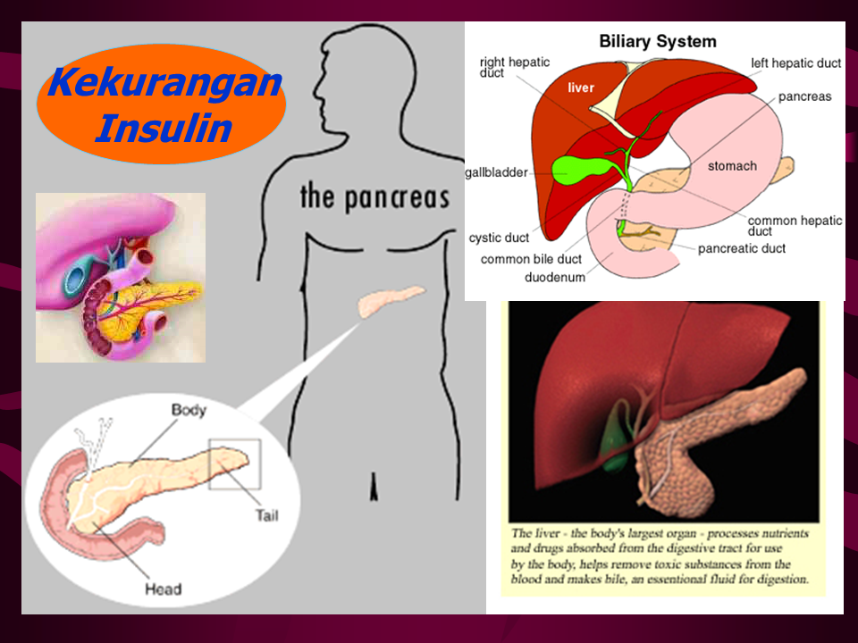 Slide PowerPoint, Diabetes Melitus, Komplikasi, Tanda 