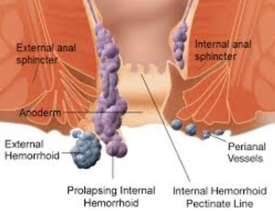 DIFFERENCE #BETWEEN ANAL FISSURES AND #HAEMORRHOIDS [#Health Anad #Wellness]