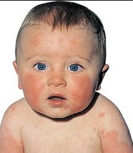 Fifth Disease Rash Pictures4