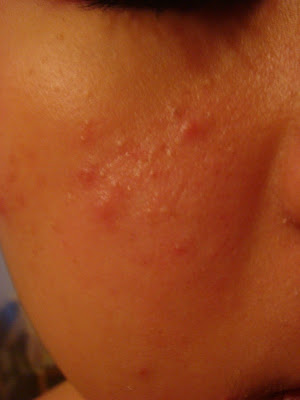 pimples bumps Pimples+on+