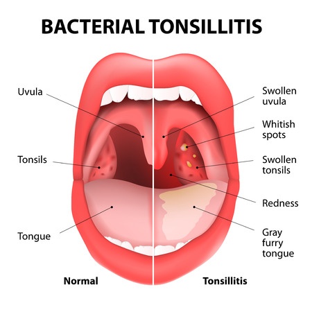 Sakit Tonsil Dan Cara Merawatnya Dengan Ubat Tonsil 