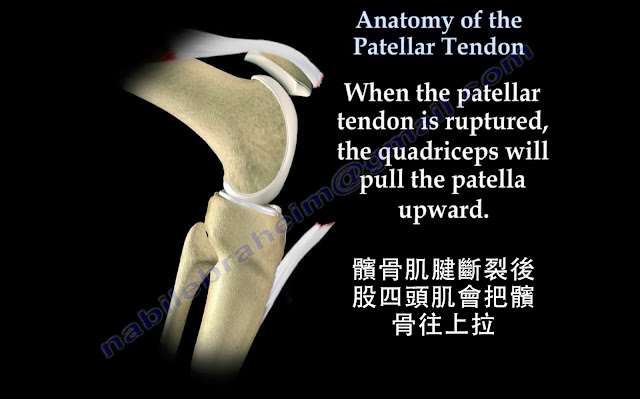 好痛痛 髕骨肌腱 斷裂