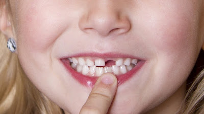 Tuổi thay răng sữa ở trẻ em