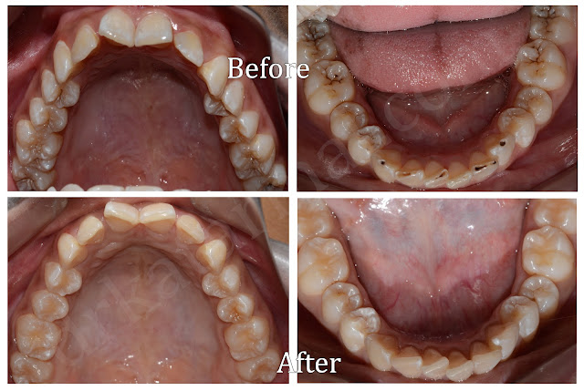 Before and After Treatment of Decayed Teeth with Composit Filling at Dr. Bharat Katarmal Dental Clinic