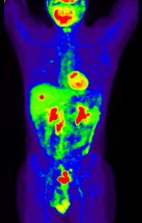 What is PET Scan?