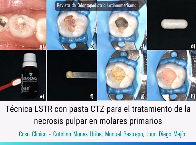 CASO CLÍNICO: Técnica LSTR con pasta CTZ para el tratamiento de la necrosis pulpar en molares primarios
