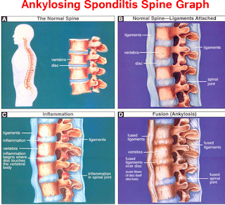 Ankylosing Spondylitis Pain Relief Medicine Of Homeopathy