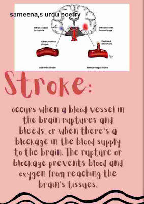 Demystifying the Different Types of Stroke: An In-depth Guide to Understanding Cerebral Vascular Accidents