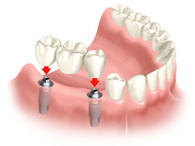 Trồng răng sứ vĩnh viễn giá bao nhiêu tiền hiện nay?-1