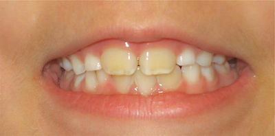 Nguyên nhân gây vàng răng ở trẻ em