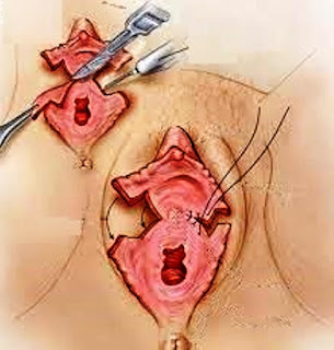 reduction labiaplasty of the labia vulva beautiful..