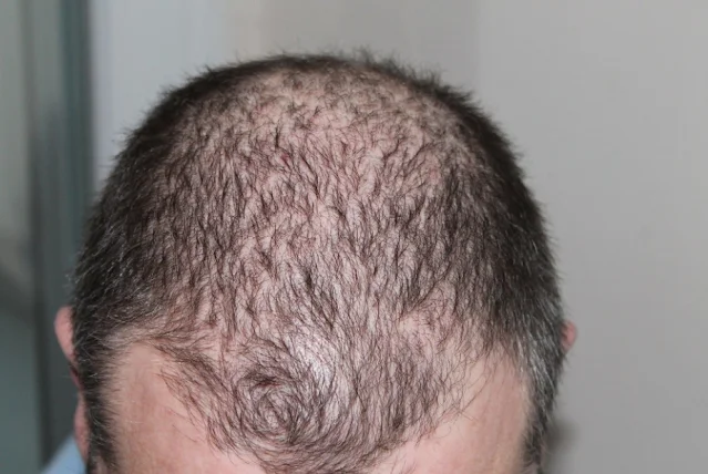 Hair Transplant Recovery