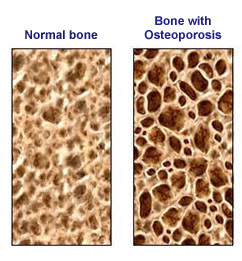 Microestructura ósea normal y en hueso osteoporótico.