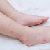 Recognizing Red Spots Signs of Dengue Fever