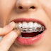 Các lý do khách hàng nên chọn niềng răng bằng nhựa
