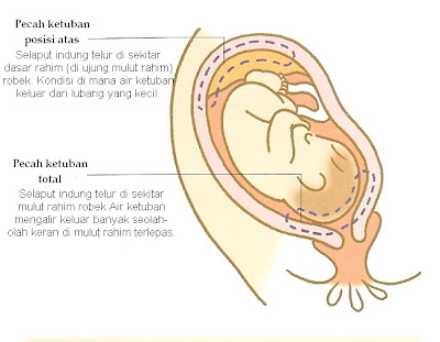 TANDA-TANDA PERSALINAN PECAH KETUBAN