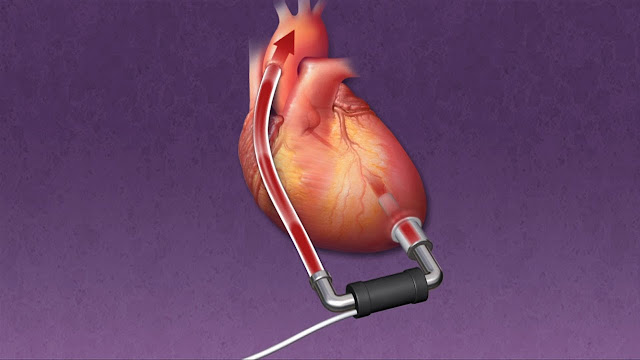 Ventricular Assist Devices (VAD) market