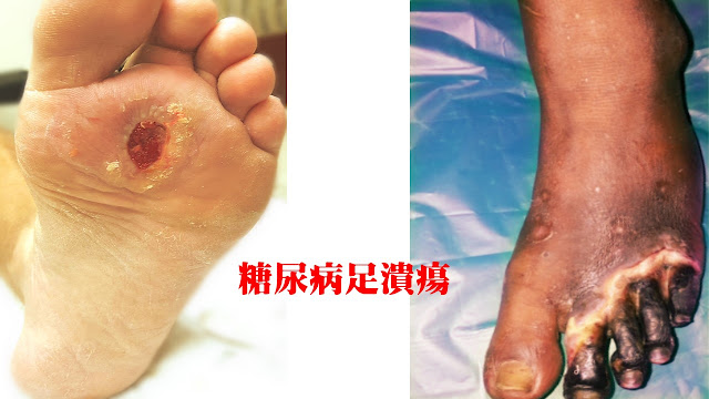 糖尿病足潰瘍（Diabetic foot ulcers）