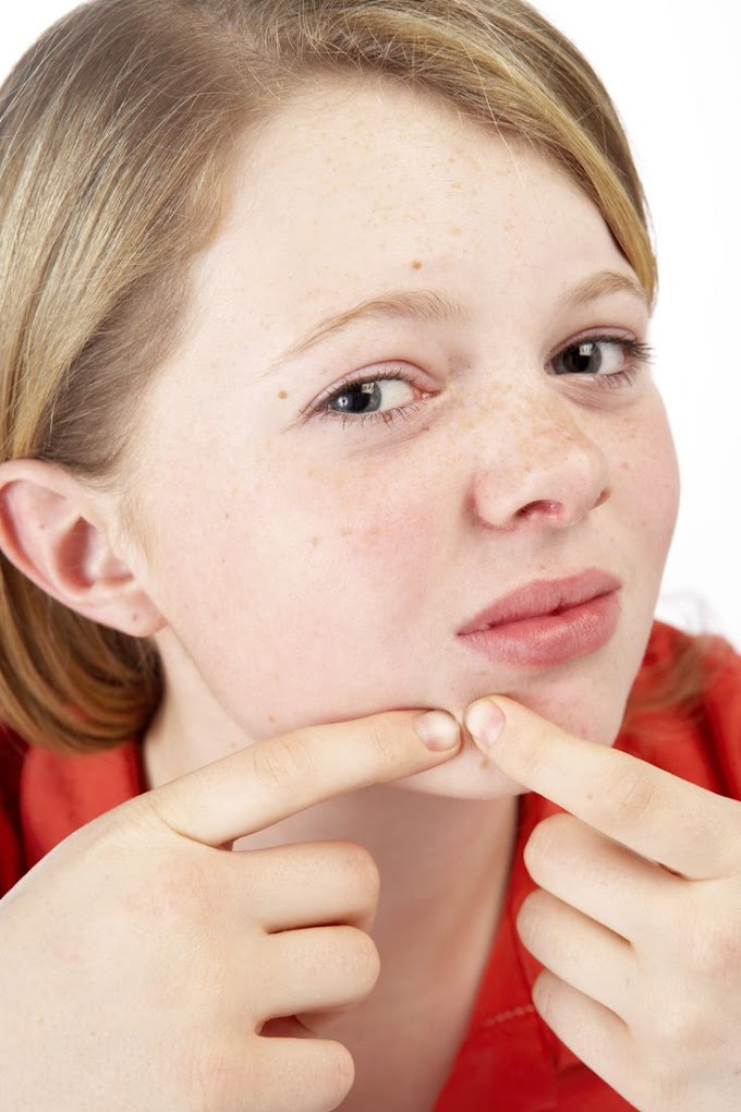  Getting rid of pimples in teenagers involves a combination of proper skincare