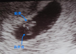 超音波写真、胎芽とお弁当、妊娠7週目