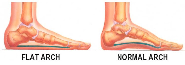 Tìm hiểu chứng bệnh bàn chân bẹt?