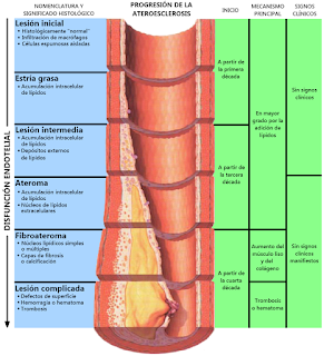   placa de ateroma, placa de ateroma formacion, ateroma calcificado, ateroma tratamiento, proceso de formacion de ateroma, como eliminar placas de ateroma, ateroma calcificado en aorta, sintomas de ateroma, ateroma aortico