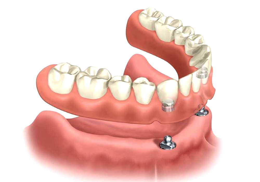 Dental Implants