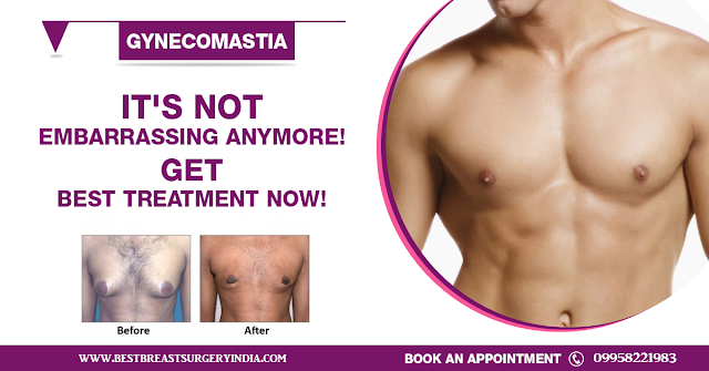 gynecomastia surgery in delhi