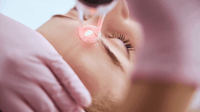 laser-treatment-for-face-barbies-beauty-bits