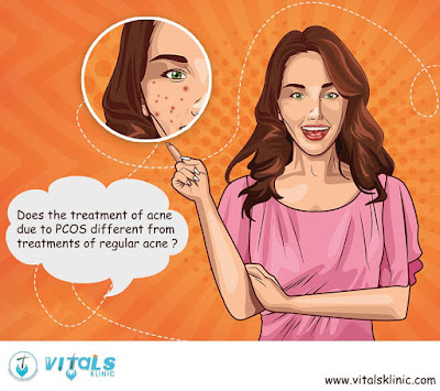 hormonal acne treatment in bangalore