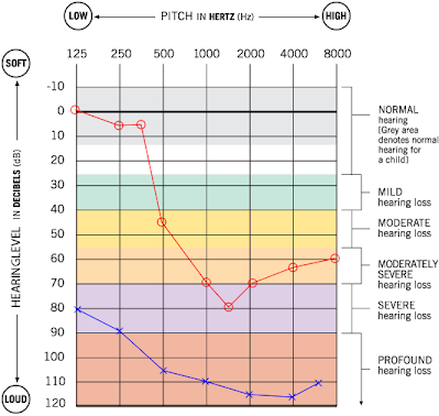 Audiogram showing normal to moderately severe hearing loss in right ear and severe to profound in left ear