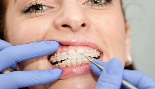 Como é o processo de colocação do aparelho dental transparente?