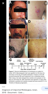 Monkeypox Pictures infected with monkeypox