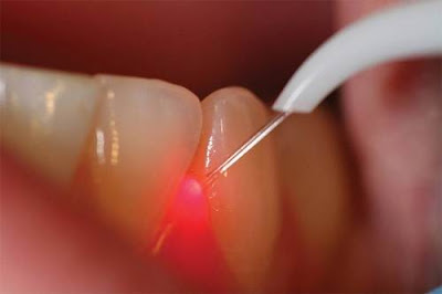 Trám răng mất bao lâu áp dụng cho răng cửa?-1