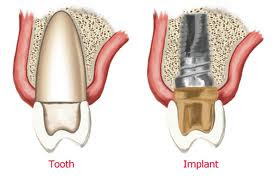 Teeth Implants Arizona